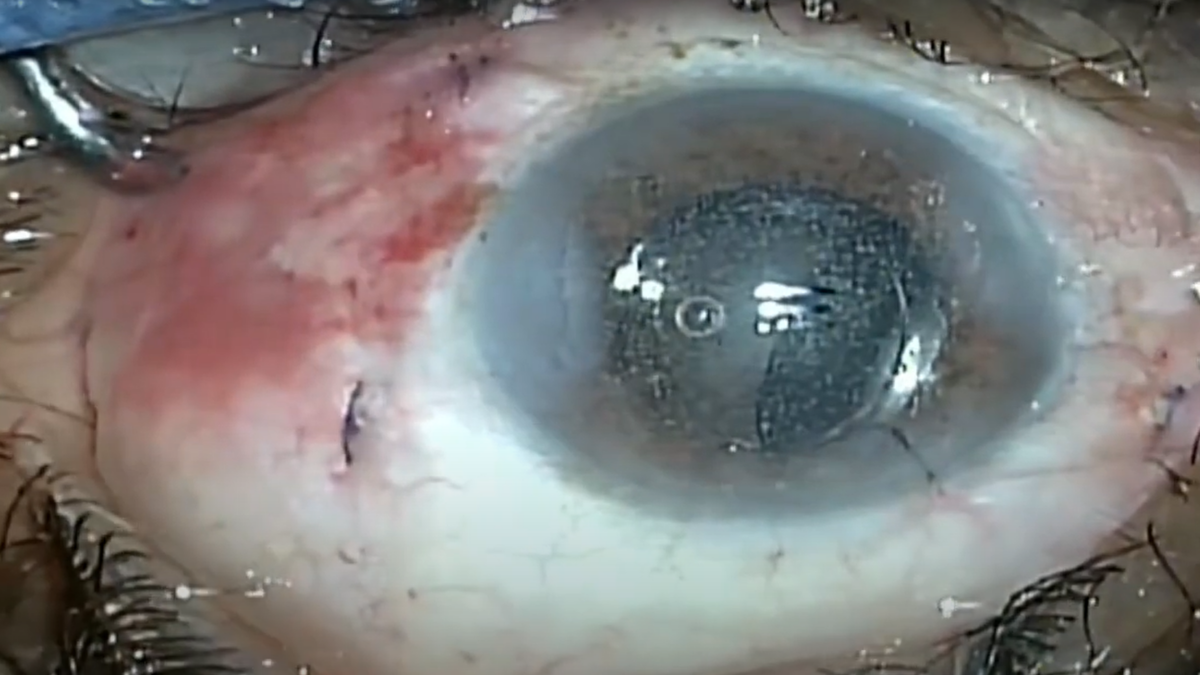 Combined Pars Plana Vitrectomy, Phaco & Intraocular implantation