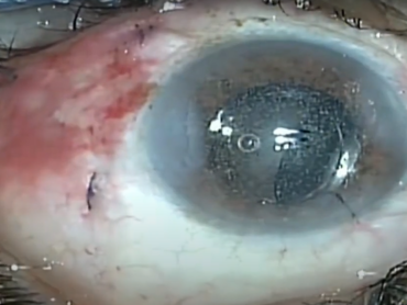 Combined Pars Plana Vitrectomy, Phaco & Intraocular implantation