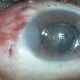 Combined Pars Plana Vitrectomy, Phaco & Intraocular implantation